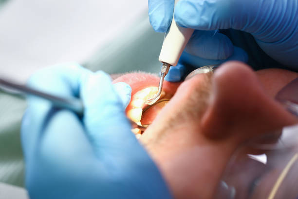 Best Emergency Wisdom Teeth Removal in Jamestown, KY