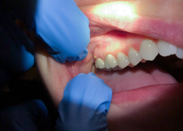 Best Emergency Tooth Extraction in Jamestown, KY